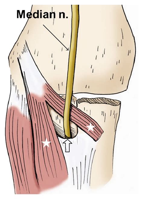 median nerve compression test at elbow|median nerve anatomy elbow.